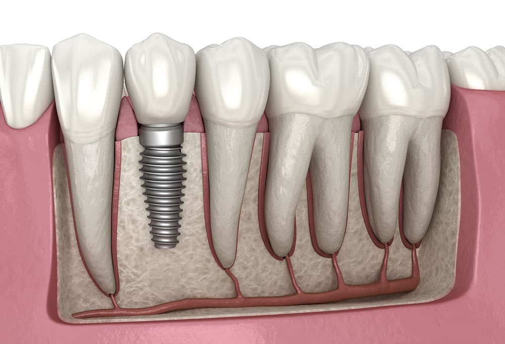 Diagram of a dental implant showing fixture, abutment and crown