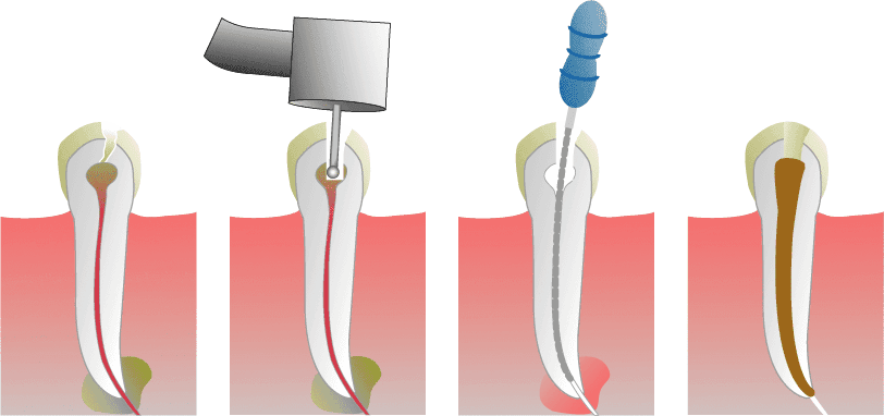 Root canal treatment illustration: decayed tooth, drilling, filing, filling