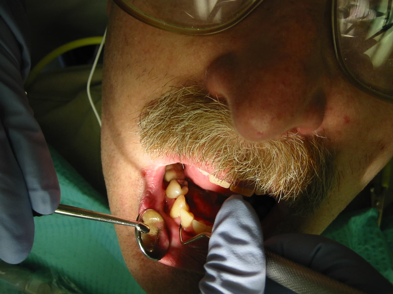 Dental hygienist performing scaling and cleaning
