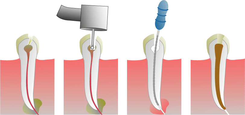 Root canal treatment illustration: decayed tooth, drilling, filing, filling